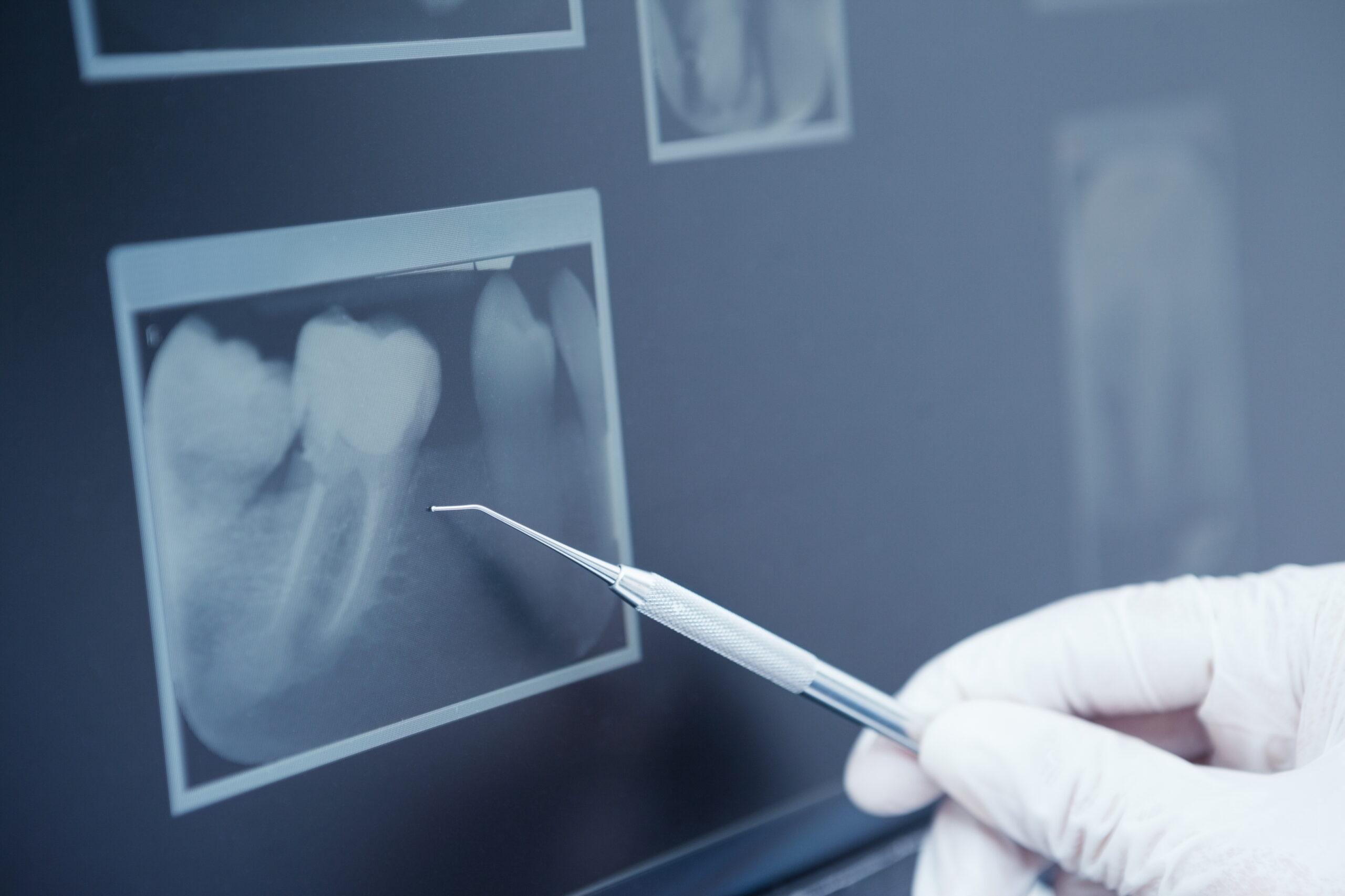 Dobry chirurg w Warszawie - implantologia MediPark. Wyrywanie zębów ósemek, wstawienie implantów zębowych, licówek.